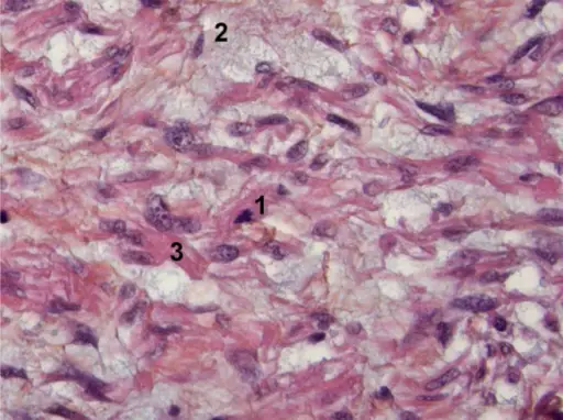 Sarcoma of the Bladder