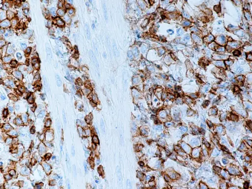 Sarcoma of the Gallbladder