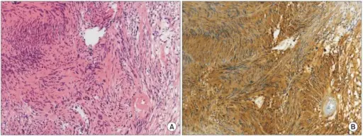 Schwannoma