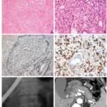 Sclerosing Retroperitoneal Fibrosis