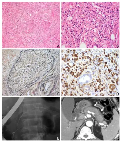 Sclerosing Retroperitoneal Fibrosis