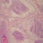 Sebaceous Adenoma