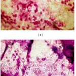 Seborrheic Dermatitis