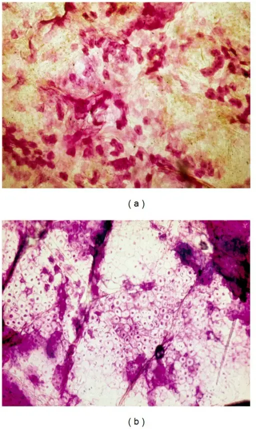 Seborrheic Dermatitis