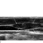 Secondary Hyperthyroidism