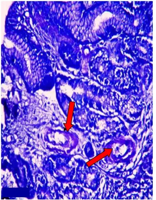 Secondary Immunodeficiencies