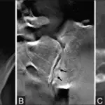 Seronegative Spondyloarthropathies