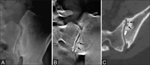 Seronegative Spondyloarthropathies