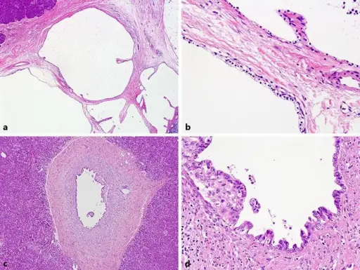 Serous Cystic Neoplasms