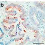 Serous Tumors of the Ovary