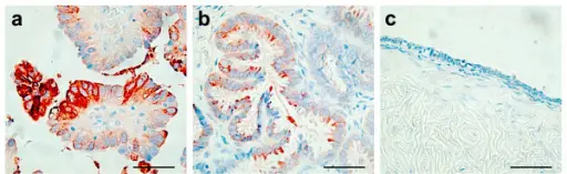 Serous Tumors of the Ovary