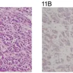 Sertoli Cell Tumors