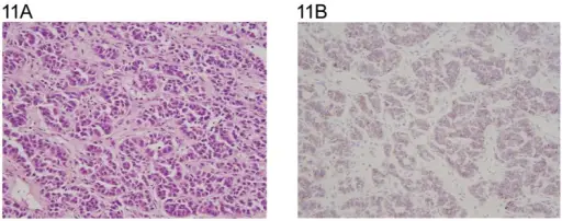 Sertoli Cell Tumors