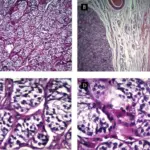 Sertoli-Leydig Cell Tumors