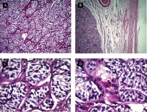 Sertoli-Leydig Cell Tumors