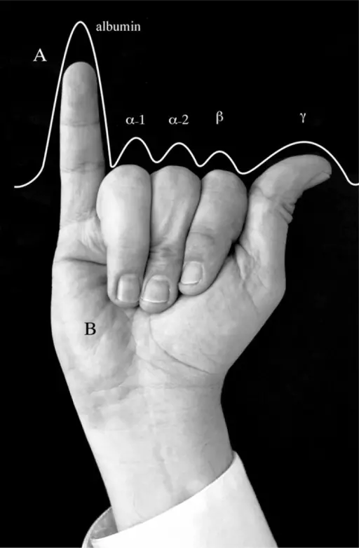 Normal Serum Protein Electrophoresis