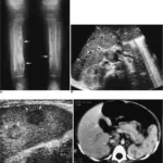 Severe Combined Immunodeficiency