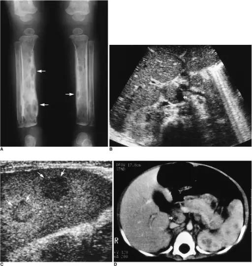 Severe Combined Immunodeficiency