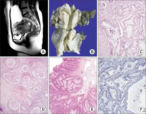 Sex Cord Stromal Tumors