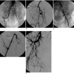 Sexual Dysfunction Related to Pituitary Gland Disorder