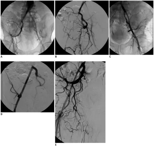 Sexual Dysfunction Related to Pituitary Gland Disorder