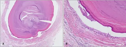 Sialolithiasis