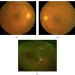 Sickle Cell Retinopathy