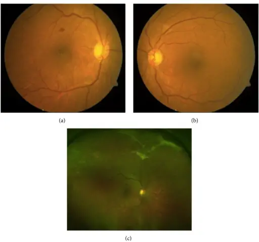 Sickle Cell Retinopathy