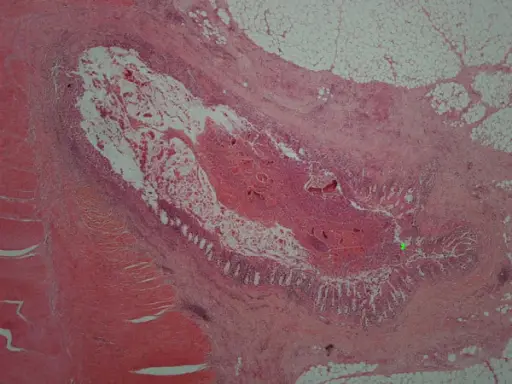 Sigmoid Diverticular Disease