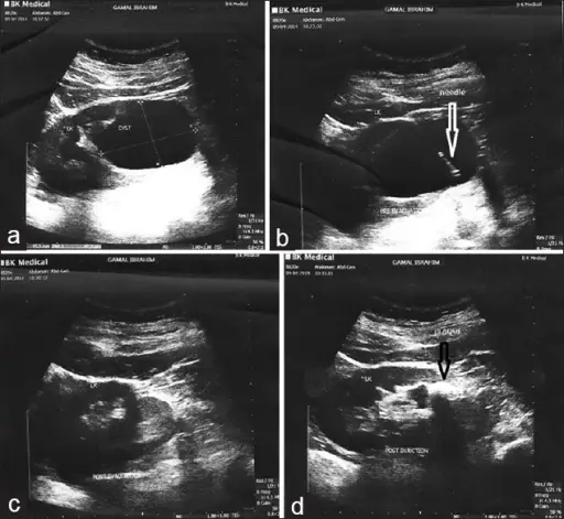 Simple Cysts of the Kidney