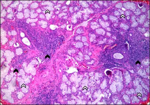 Sjögren Syndrome