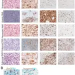 Skeletal Muscle Tumors