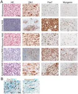 Skeletal Muscle Tumors