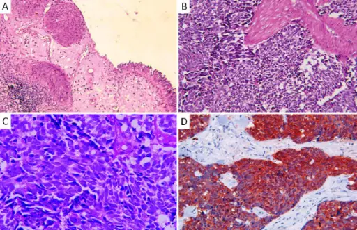 Small Cell Carcinoma of the Bladder