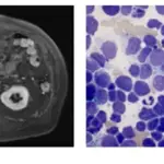 Small Cell Carcinoma of the Gallbladder