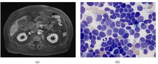 Small Cell Carcinoma of the Gallbladder