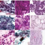 Small Cell Carcinoma of the Lung