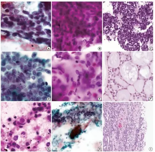 Small Cell Carcinoma of the Lung