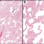 Smoking-Related Interstitial Diseases that Cause Restrictive Lung Diseases