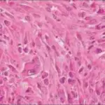 Smooth Muscle Tumors