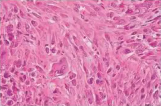 Smooth Muscle Tumors