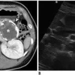 Solid-Pseudopapillary Neoplasm