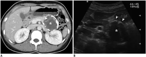 Solid-Pseudopapillary Neoplasm