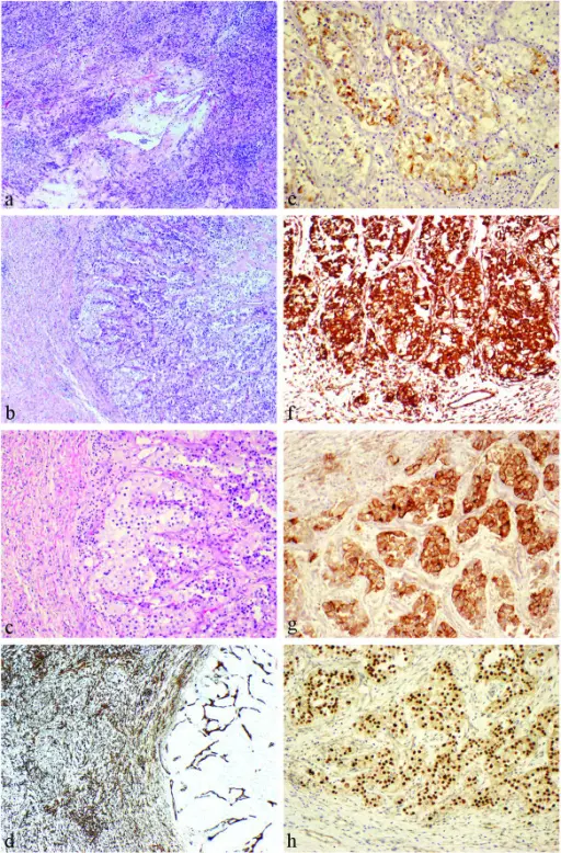 Solitary Fibrous Tumor