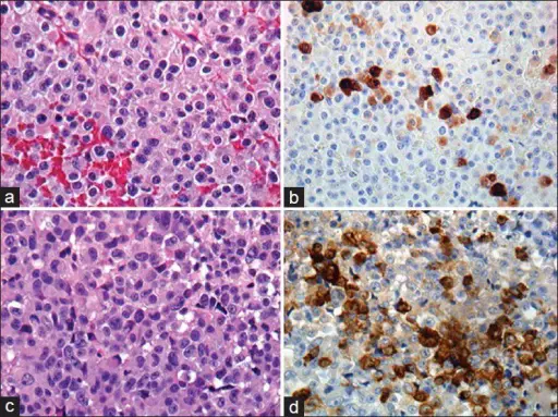 Somatotroph Adenomas