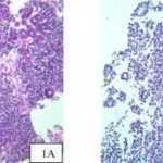 Neonatal Testicular Torsion