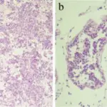 Spermatocytic Seminoma