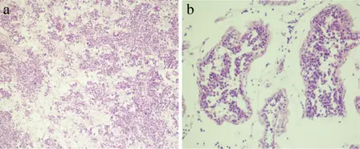 Spermatocytic Seminoma