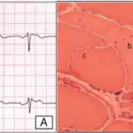 Spinobulbar Muscular Atrophy