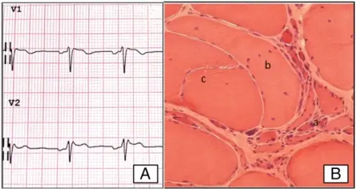 Spinobulbar Muscular Atrophy